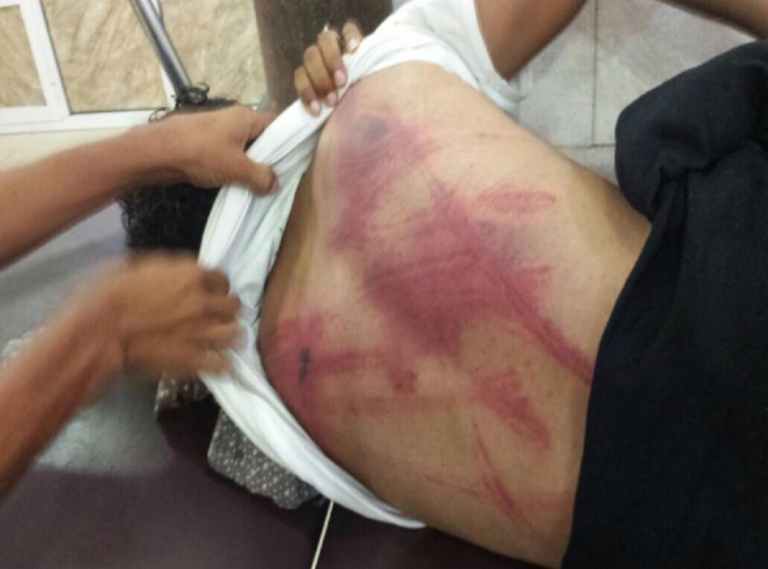 Student from Taiz subjected to torture by Aden’s security belt members