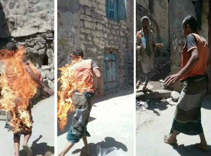 Fire set to young psychopath in Yemen’s militia-controlled province of Ibb